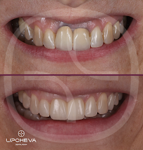 Д-р Ваня Липчева - Пародонтология | Имплантология | Естетика | Dr. Vanya Lipcheva - Periodontology | Implantology | Esthetics