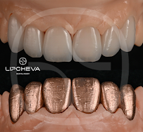 Д-р Ваня Липчева - Пародонтология | Имплантология | Естетика | Dr. Vanya Lipcheva - Periodontology | Implantology | Esthetics