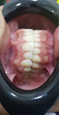 Elite Smile | Diseño de Sonrisa | Porcelain Veneers Barranquilla