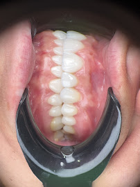 Elite Smile | Diseño de Sonrisa | Porcelain Veneers Barranquilla
