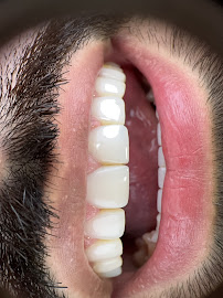 Elite Smile | Diseño de Sonrisa | Porcelain Veneers Barranquilla