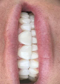 Elite Smile | Diseño de Sonrisa | Porcelain Veneers Barranquilla