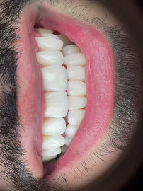 Elite Smile | Diseño de Sonrisa | Porcelain Veneers Barranquilla