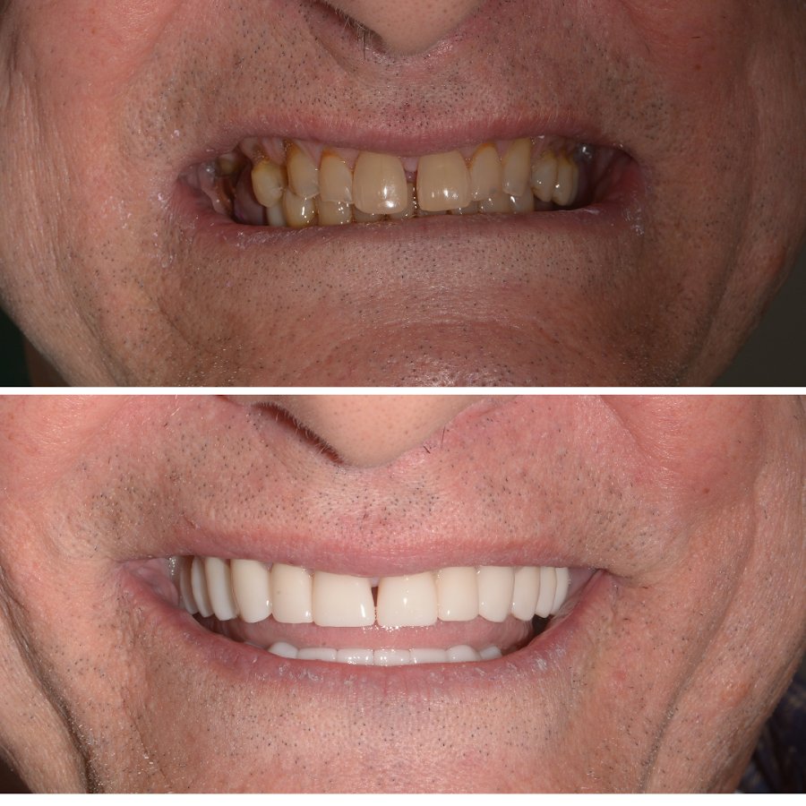 Before/after dental result at Dental Centar Repic