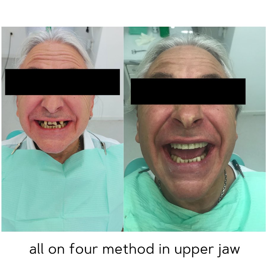 Before/after dental result at Dental Centar Repic