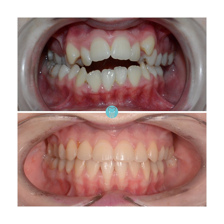 Before/after dental result at Dental Centar Repic