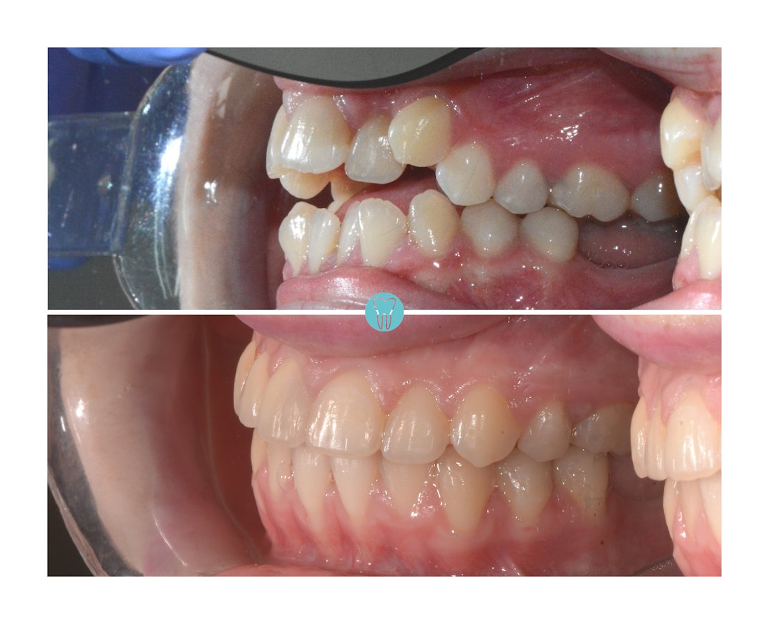Before/after dental result at Dental Centar Repic