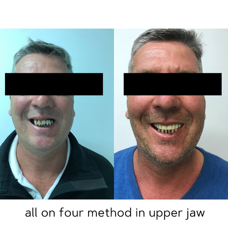 Before/after dental result at Dental Centar Repic