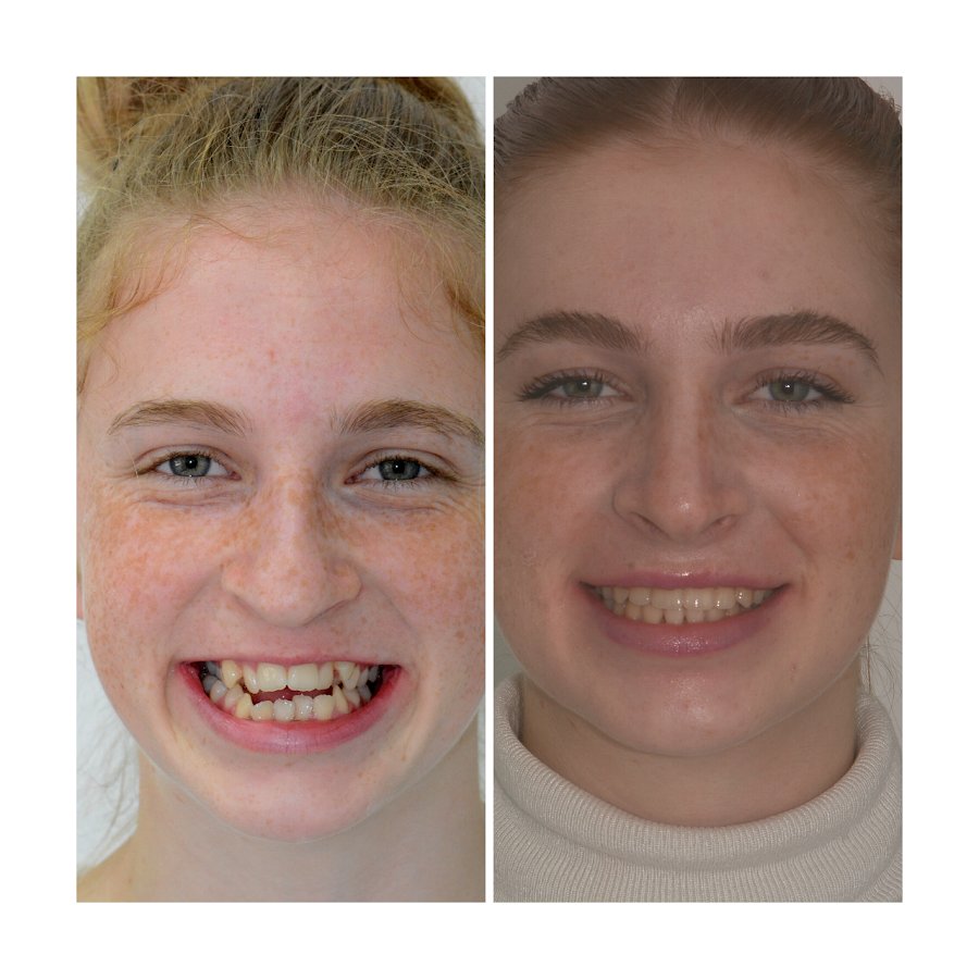Before/after dental result at Dental Centar Repic