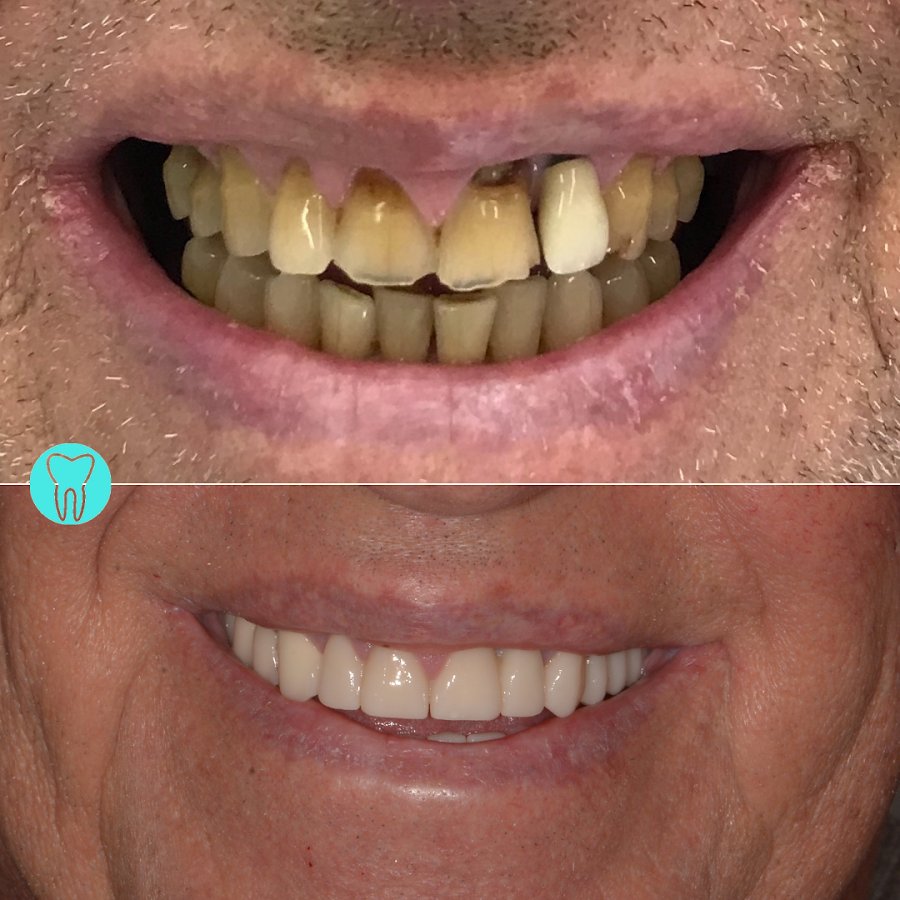 Before/after dental result at Dental Centar Repic