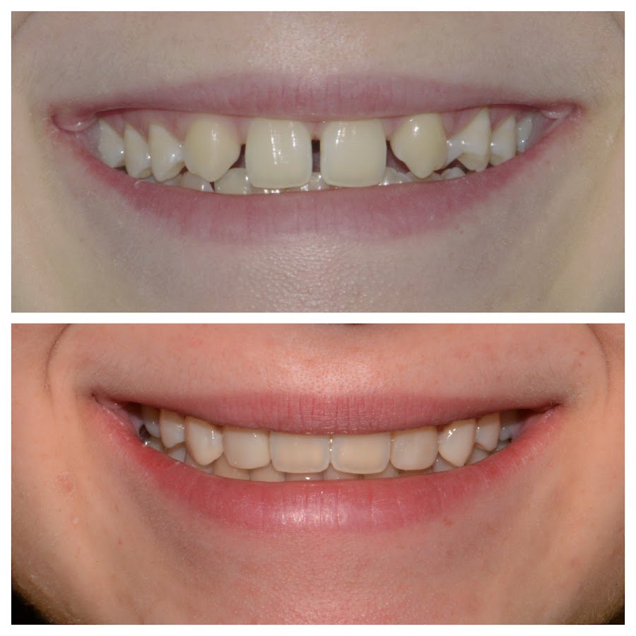 Before/after dental result at Dental Centar Repic