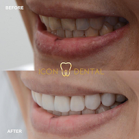 Icon Dental Kepong ( Invisalign Diamond Provider , Veneers, Implant)