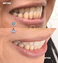 Icon Dental Kepong ( Invisalign Diamond Provider , Veneers, Implant)