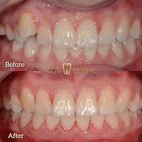 Icon Dental Kepong ( Invisalign Diamond Provider , Veneers, Implant)