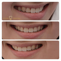 Icon Dental Kepong ( Invisalign Diamond Provider , Veneers, Implant)