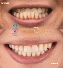 Icon Dental Kepong ( Invisalign Diamond Provider , Veneers, Implant)