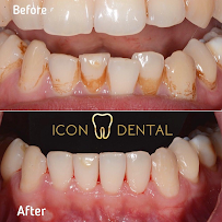 Icon Dental Kepong ( Invisalign Diamond Provider , Veneers, Implant)