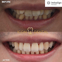 Icon Dental Kepong ( Invisalign Diamond Provider , Veneers, Implant)