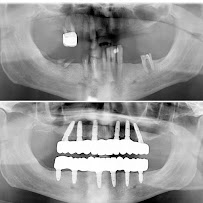 BioDent - Dental implantation