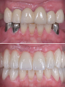 BioDent - Dental implantation
