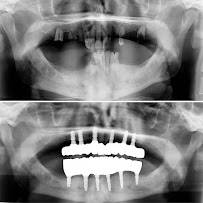 BioDent - Dental implantation