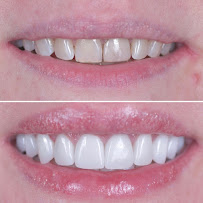 BioDent - Dental implantation