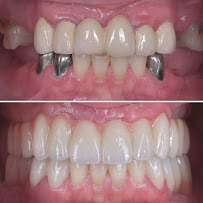 BioDent - Dental implantation