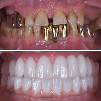 BioDent - Dental implantation