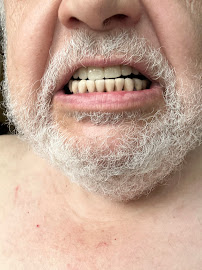BioDent - Dental implantation