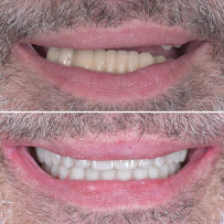 BioDent - Dental implantation