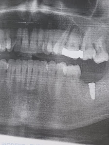 BioDent - Dental implantation