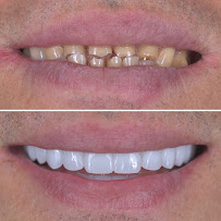 BioDent - Dental implantation