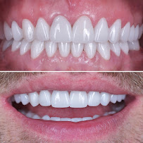 BioDent - Dental implantation