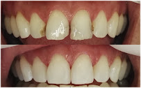FullDent
