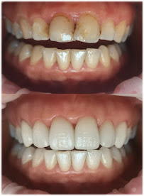 FullDent