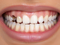Clínica Dental Protesis Inmediatas