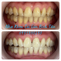 Nha Khoa Sài Gòn Bình Tân