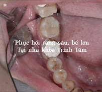 Nha khoa Trinh Tâm | Nha khoa trẻ em Tân Phú | Nha khoa nhổ răng khôn Tân Phú