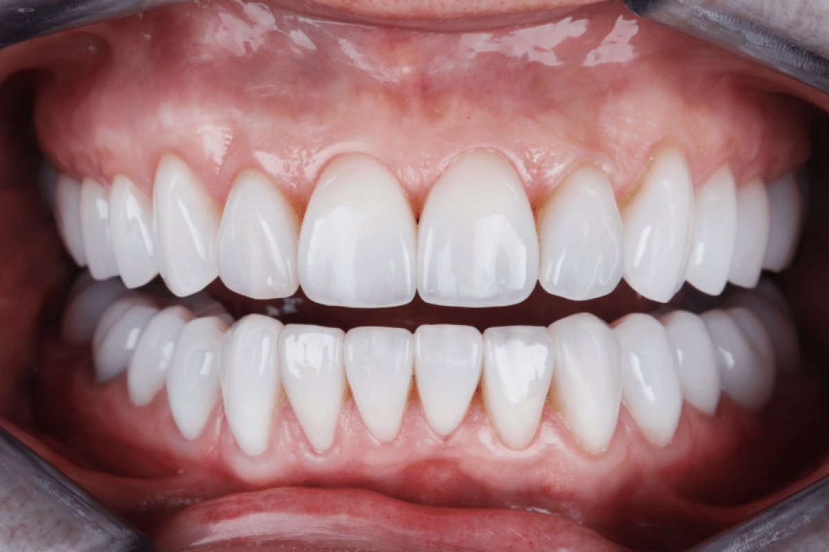 Are Veneers Worth It?