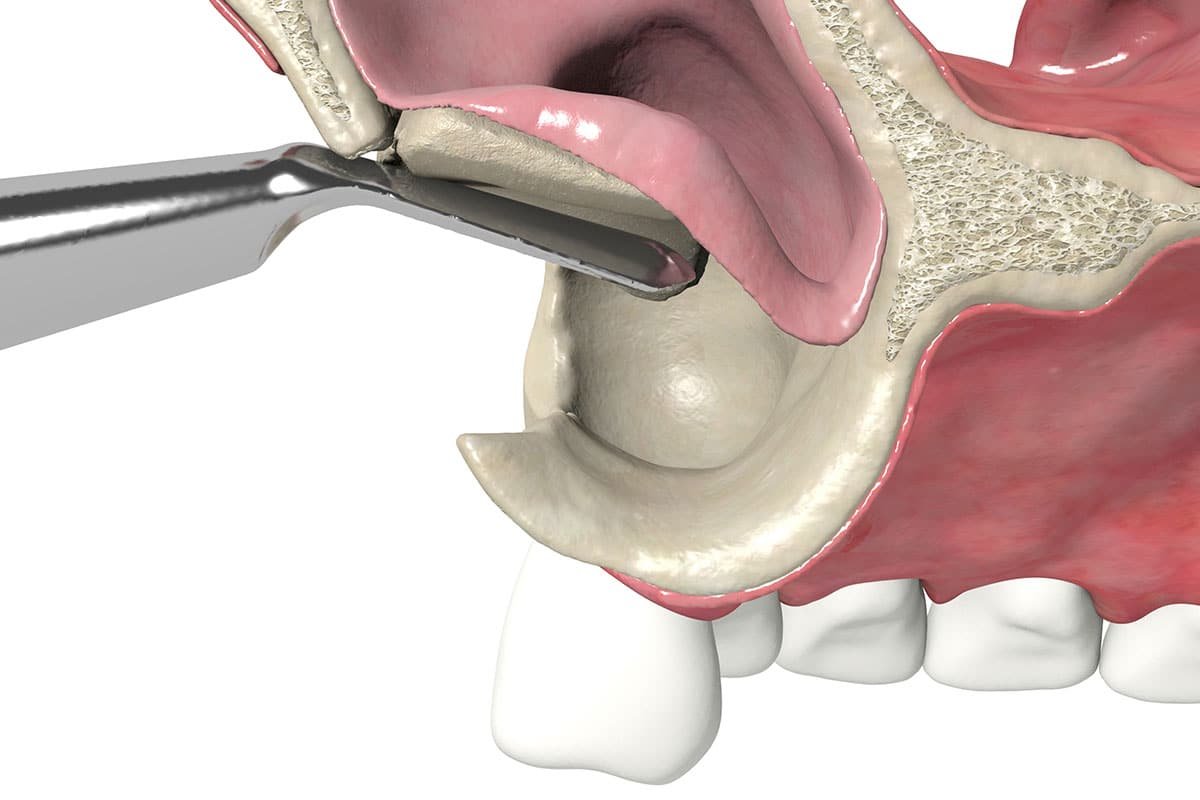 Sinus Lifting in Vietnam: Cost Guide 2026