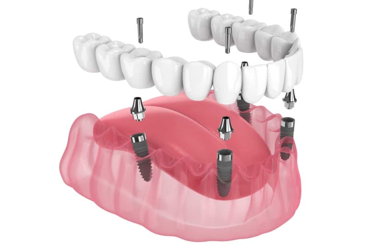 All-on-4 Dental Implants in Krakow: Full Arch Restoration for International Patients (2026)