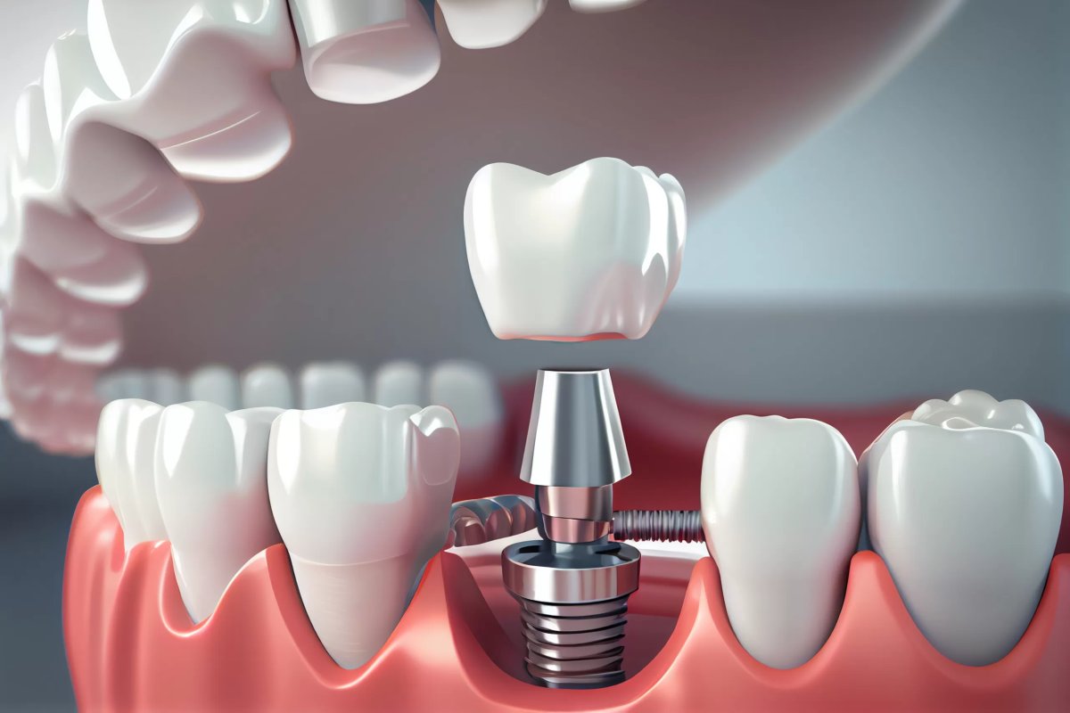 Dental Implants Hanoi vs Australia: Full Cost Comparison