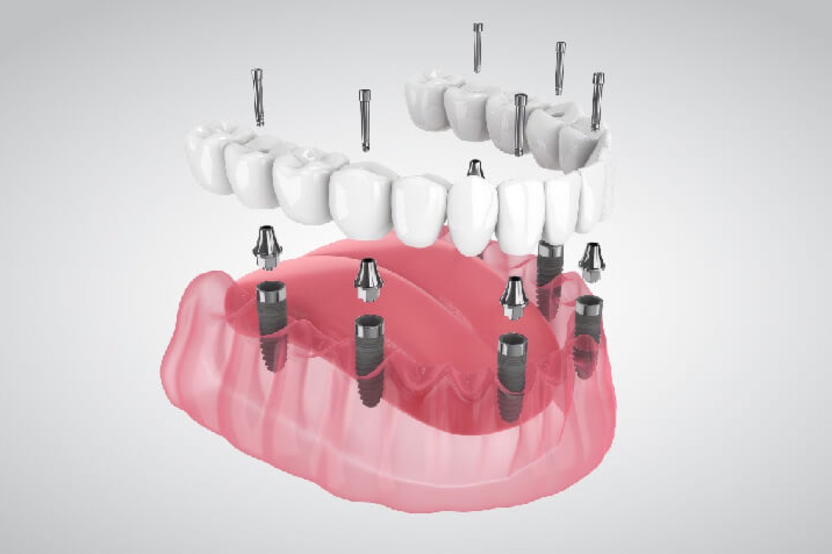 All-on-6 in Krakow: When Six Implants Are Better Than Four (2026)