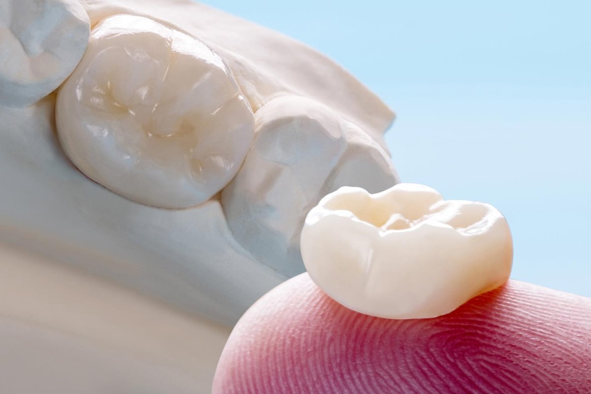 Zirconia Crowns in Hoi An: Cost, Clinics & What to Expect 2026