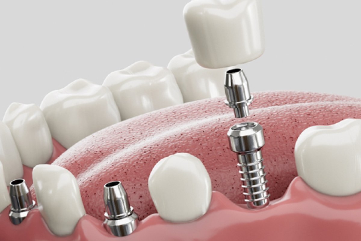 The Complete Guide to Dental Implants in Vietnam: Costs, Brands & Success Rates (2026)