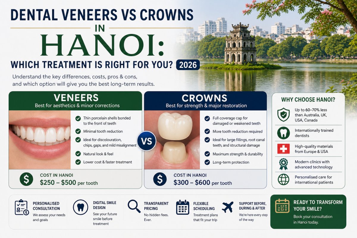 Dental Veneers vs Crowns in Hanoi: Which Treatment Is Right for You? 2026