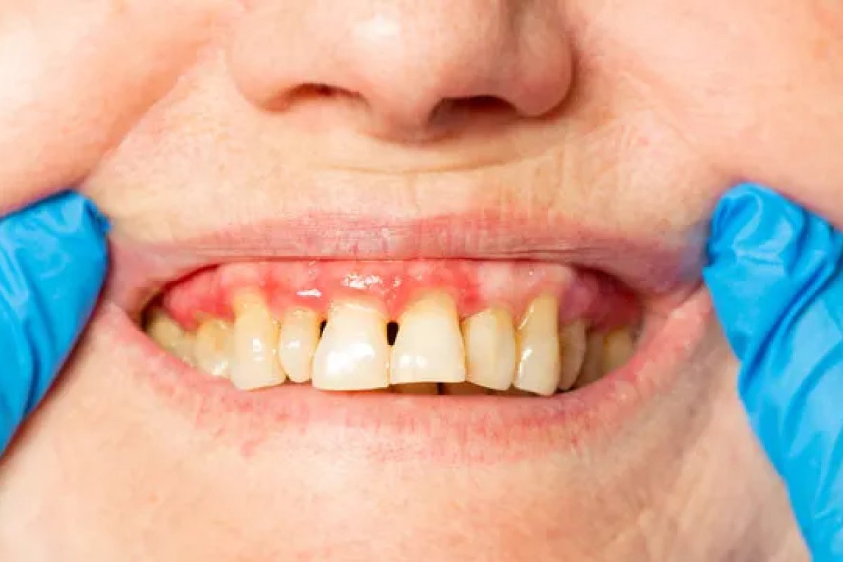 What Is the Best Toothpaste for Periodontal Disease? (2026)