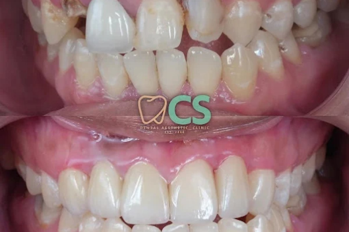 Veneers at CS DENTAL BALI: Process, Materials, and What to Know Before You Go
