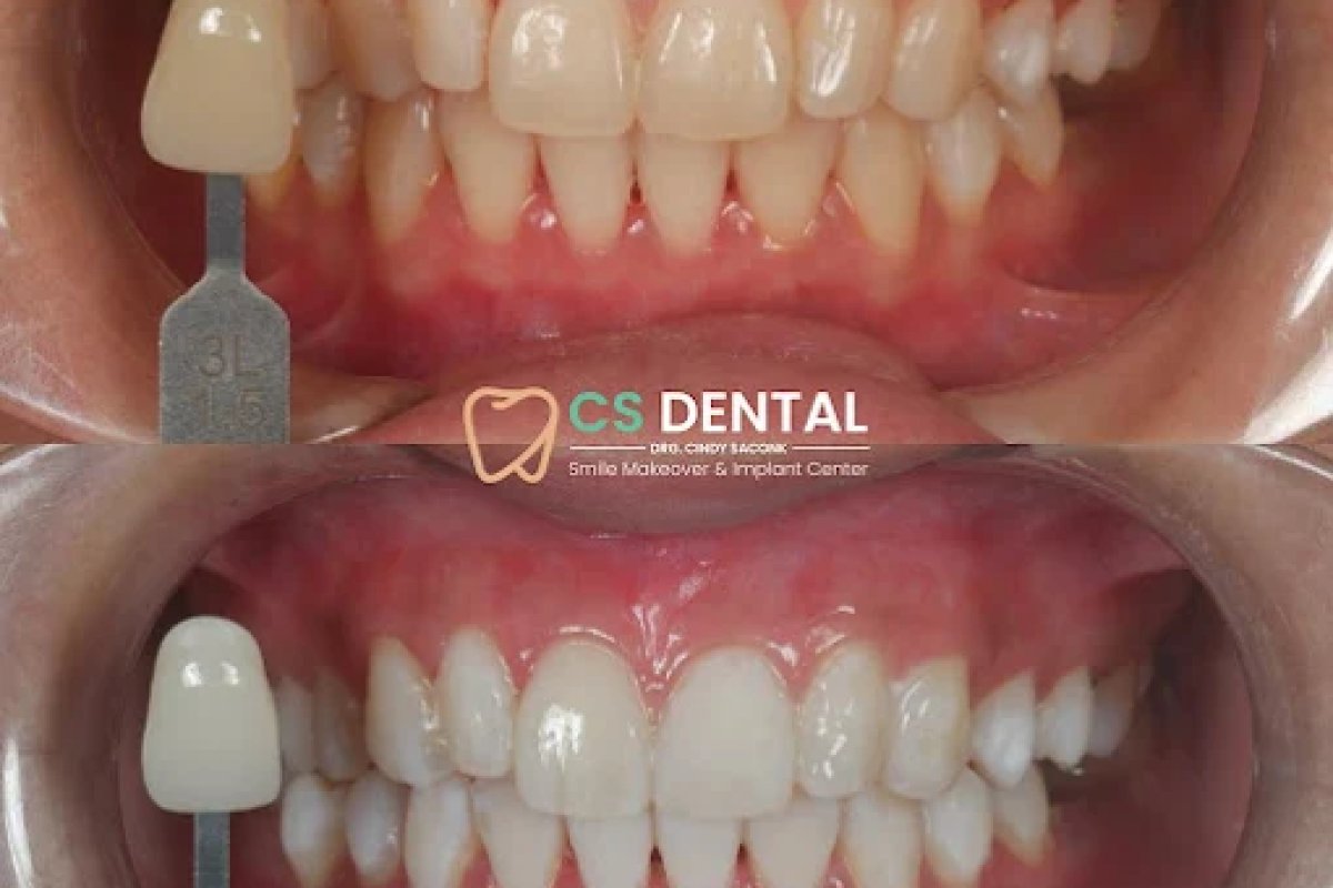 Teeth Whitening at CS DENTAL BALI: In-Chair Options and What to Expect