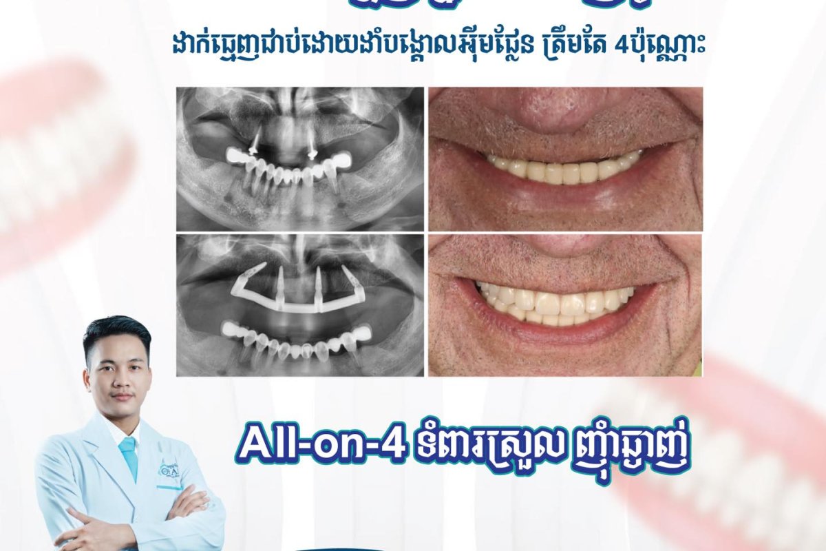 Full-Mouth Rehabilitation at Moral Dental Clinic: Is It the Right Fit?